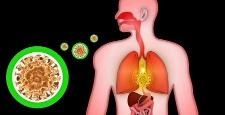 Image of chronic lung inflammation 