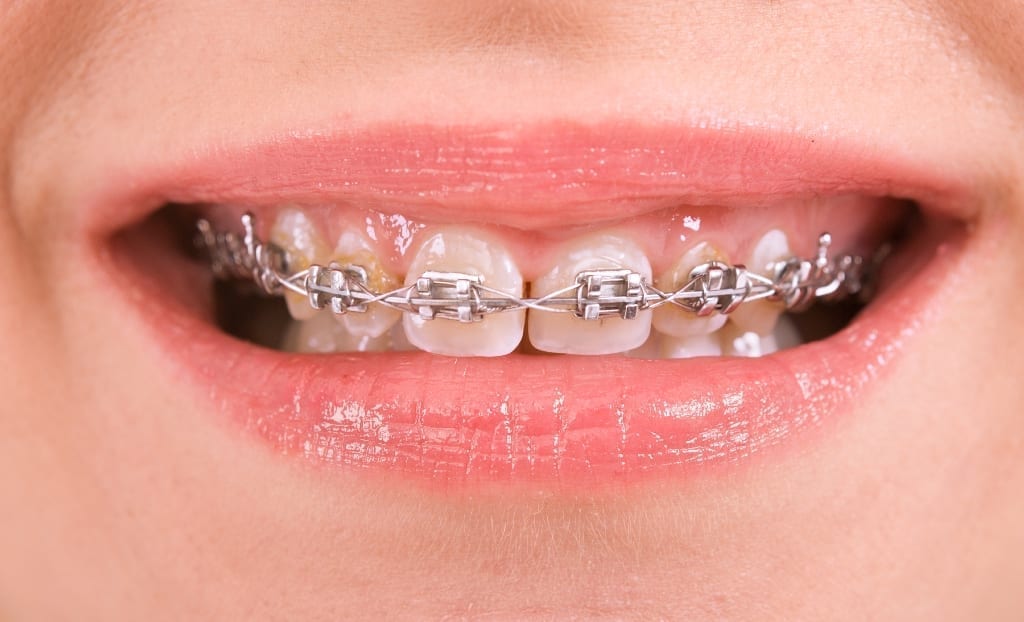 Close up of a mouth with traditional braces