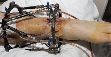 Broken, and stabilized lower leg