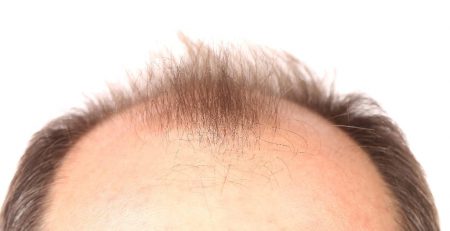 Researchers believe they've found an effective treatment for treating hair-loss