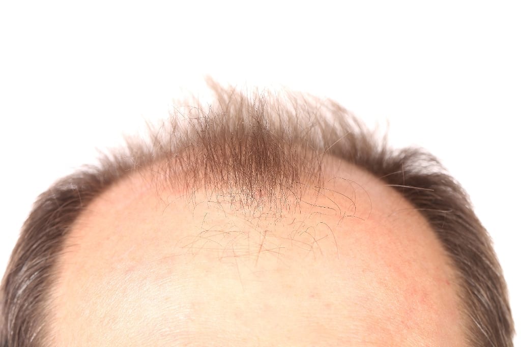 Researchers believe they've found an effective treatment for treating hair-loss