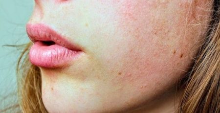researchers now believe they may have unearthed a previously unknown genetic cause that appears to make certain sufferers more predisposed to acne