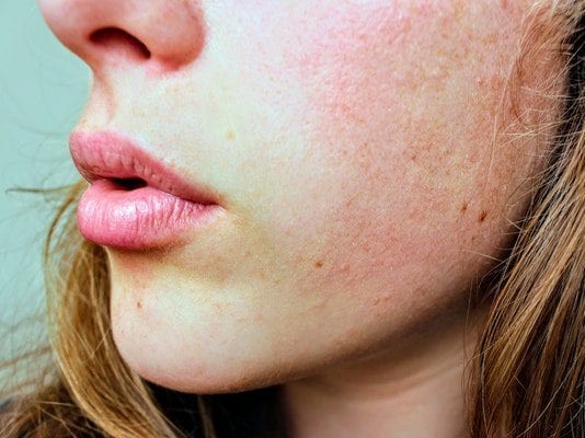 researchers now believe they may have unearthed a previously unknown genetic cause that appears to make certain sufferers more predisposed to acne