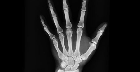 Romosozumab (brand name Evenity), “restores bone without breaking it down, according to the findings of two large clinical trials