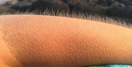 Researchers Uncover a New Reason for Goosebumps