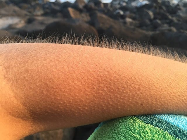 Researchers Uncover a New Reason for Goosebumps